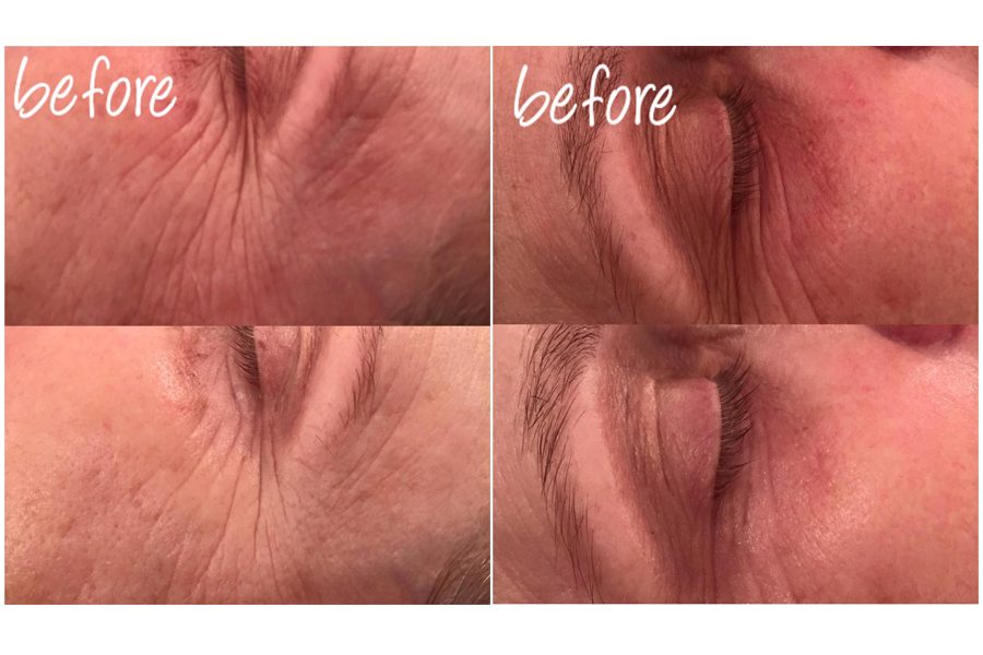 before & afters - collagen power facial copy