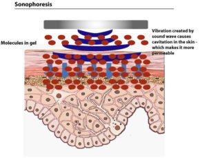 sonophoresis